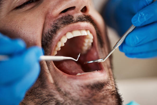 Best Urgent Care for Lost Fillings or Crowns in Woodbury, MN
